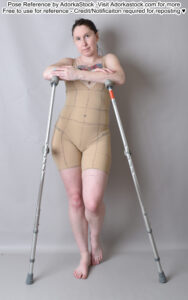 A white woman with two crutches on either side of her, standing on one leg.